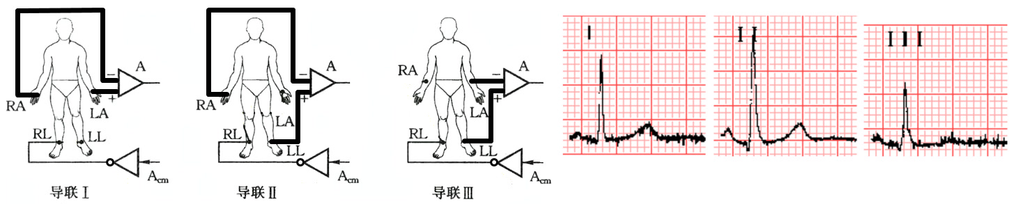 标准肢体导联